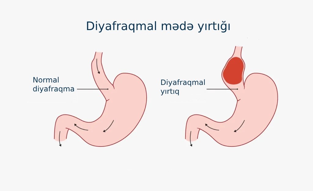 diyafraqmal mədə yırtığı
