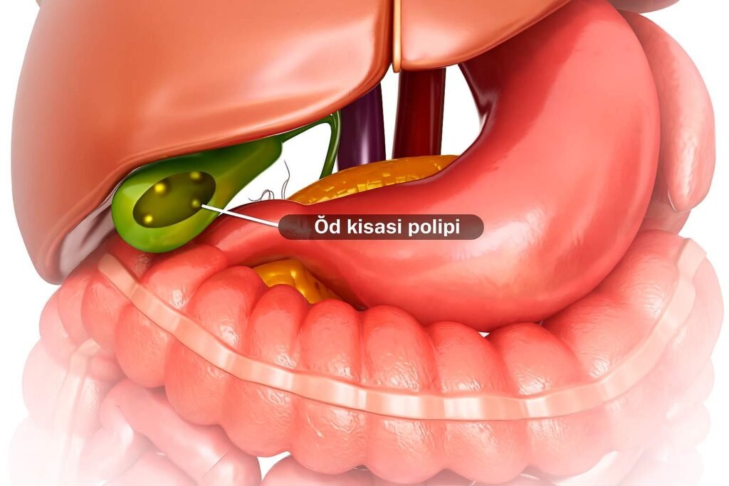 öd kisəsində polip
