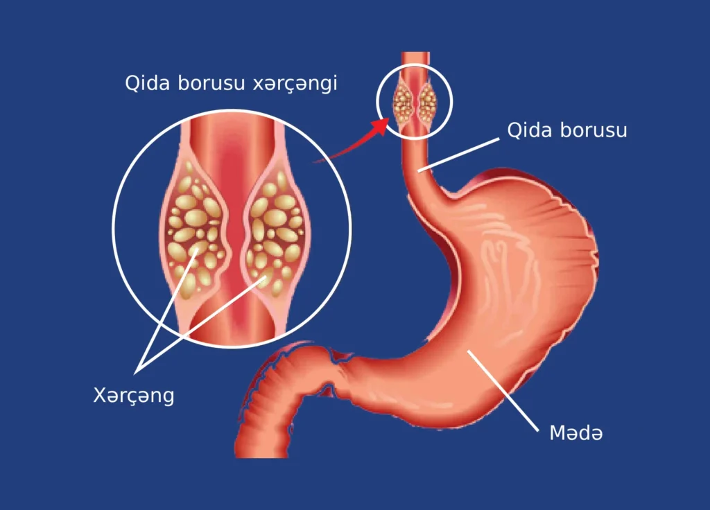qida borusu xərçəngi