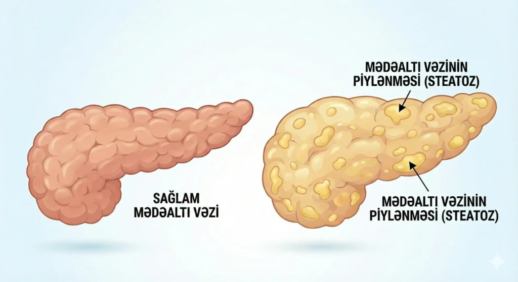 Mədəaltı vəzi piylənməsi (yağlanması) əlamətləri və müalicəsi