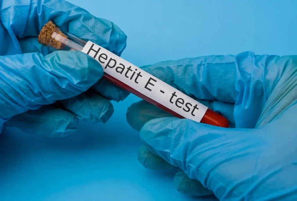 Hepatit E xəstəliyinin əlamətləri və müalicəsi